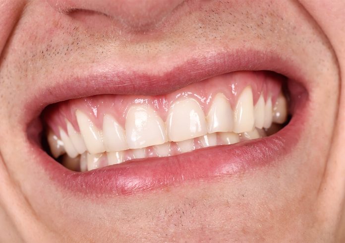 Dentist For Gum Disease Treatment In West Chester PA
