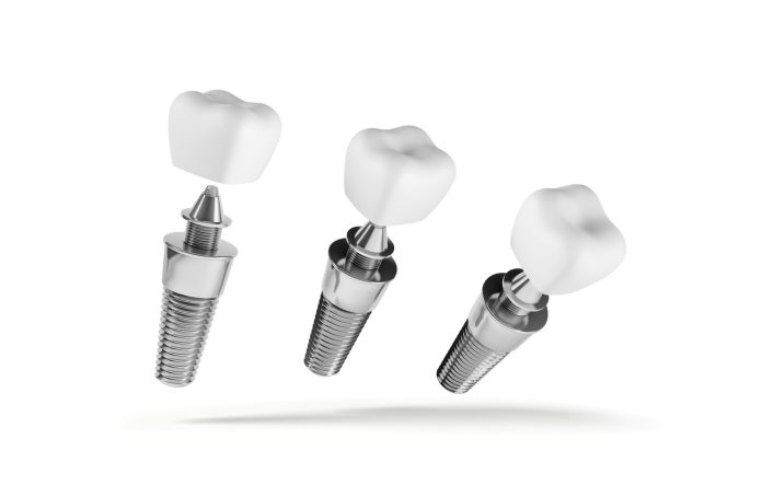 Restoring Missing Teeth with Dental Implants – Summit Dental Health