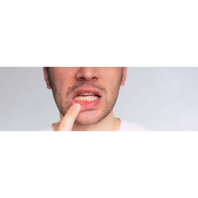 Why do men get bleeding gums more often than women?