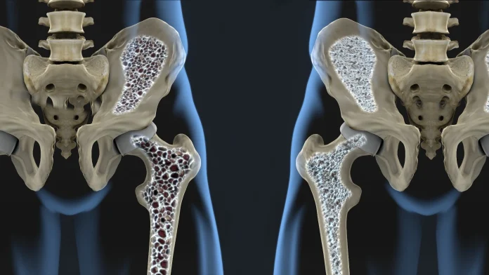 Routine blood test may flag hidden osteoporosis risk, study finds