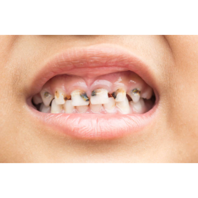What I’m doing about my 8-year-old granddaughter’s cavity