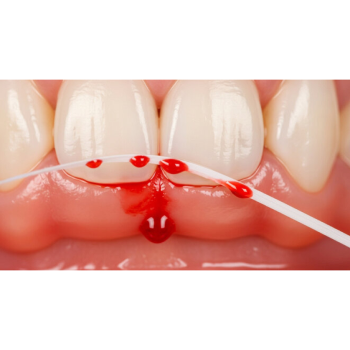 If your gums bleed, this seal is already failing
