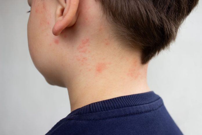 Measles Outbreak in South Carolina Is Growing—What To Know