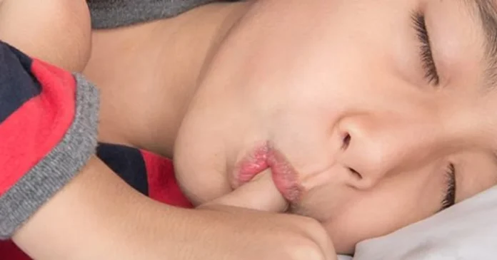 How thumb-sucking can be detrimental for children’s oral health