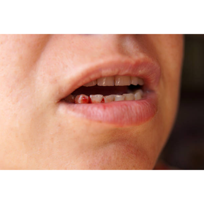 Bleeding gums are a vital sign